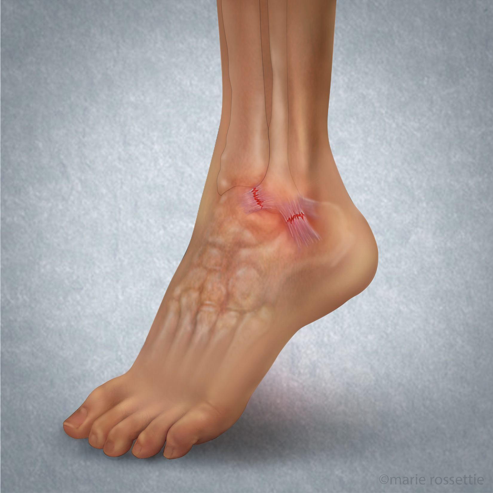 Low Ankle Sprain