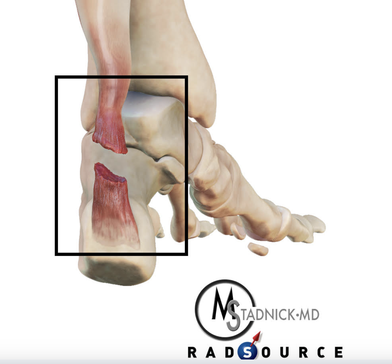 Achilles Anatomy