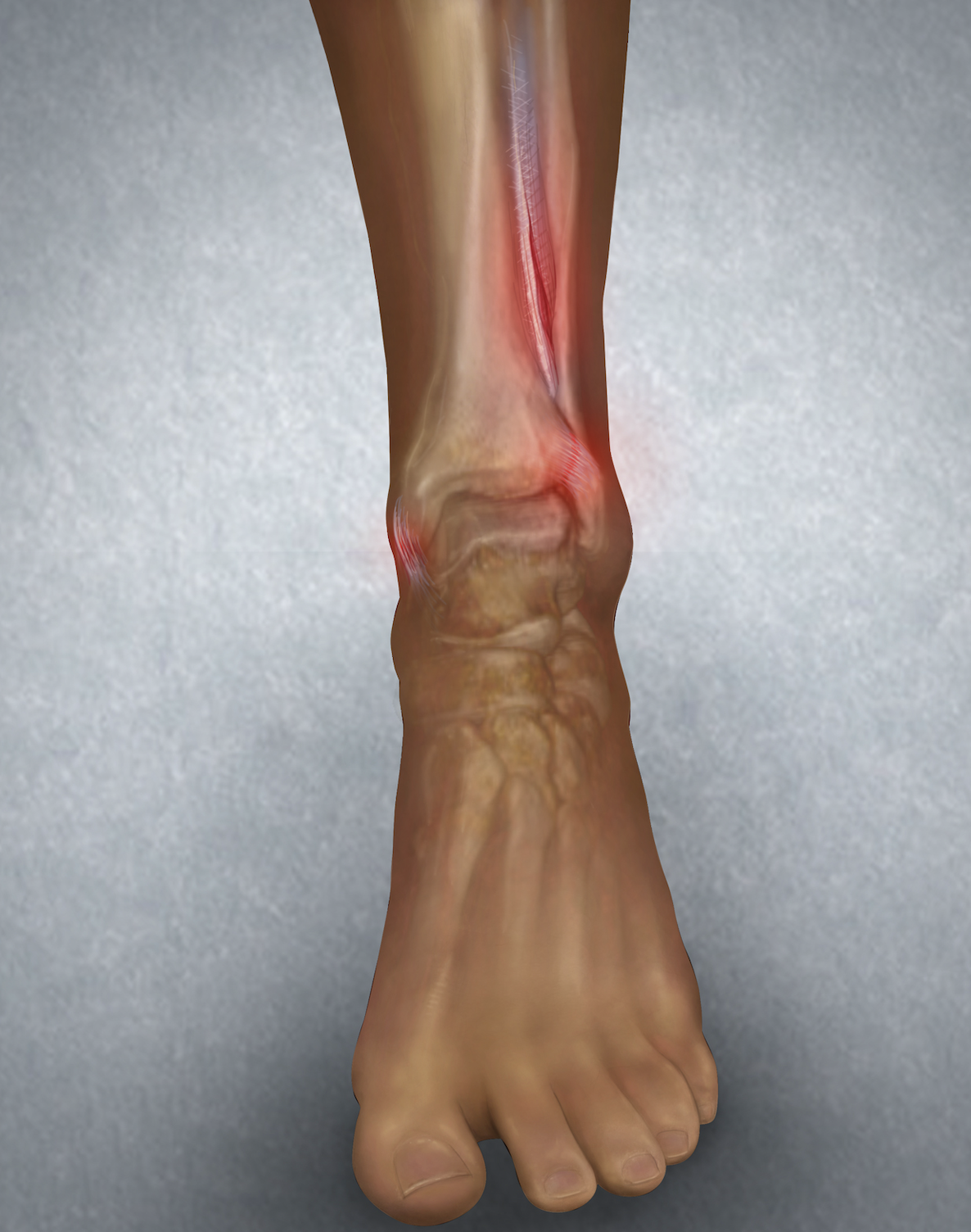 High Ankle Sprain